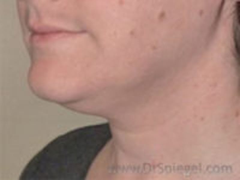 Neck Lift Before & After Gallery - Patient 157140155 - Image 1