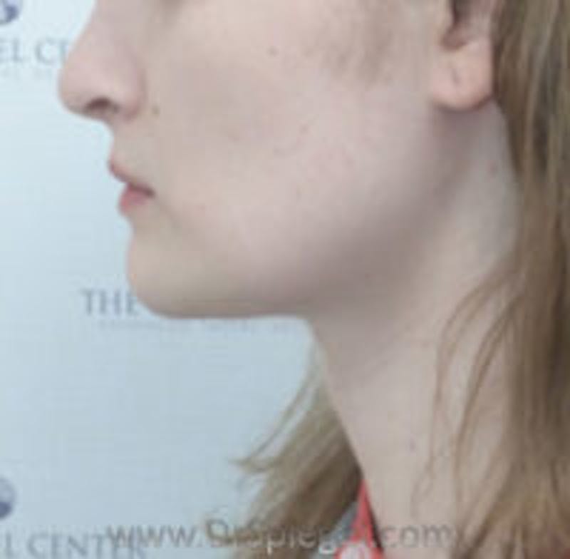Trachea Shave Before & After Gallery - Patient 157140150 - Image 2