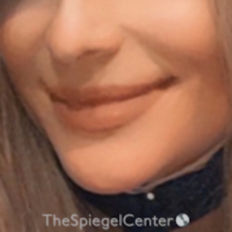 Lip Lift Before & After Gallery - Patient 157140153 - Image 2