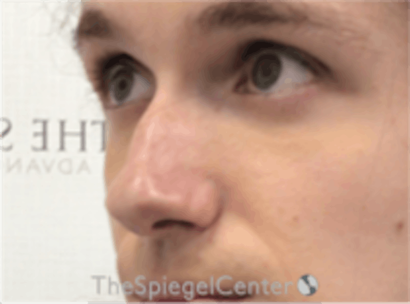 Rhinoplasty Before & After Gallery - Patient 157140158 - Image 1