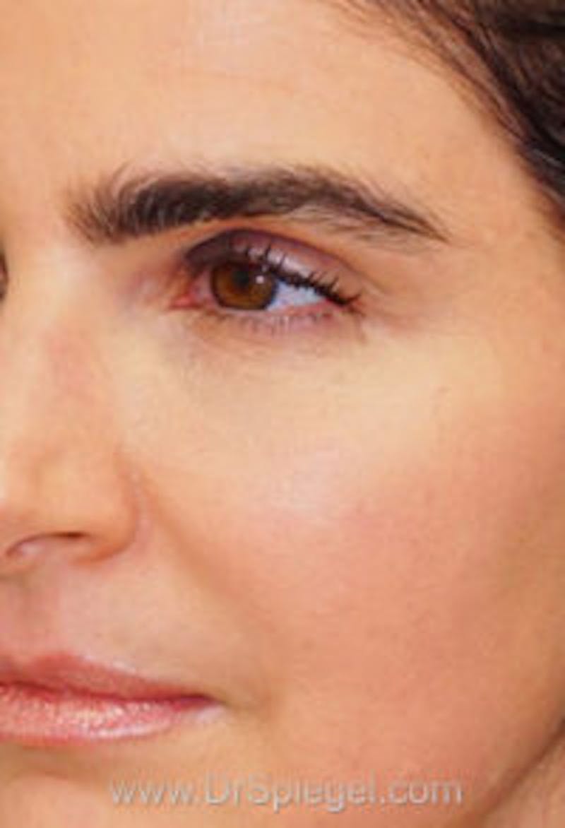 Botox / Dysport / Jeuveau / Xeomin Before & After Gallery - Patient 157140154 - Image 6
