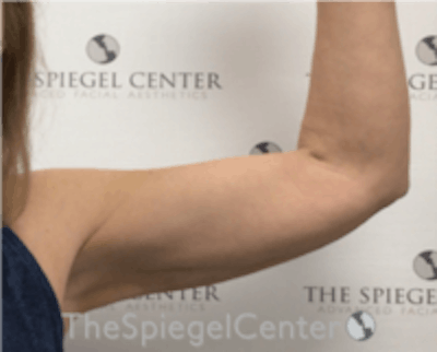 Bodytite Before & After Gallery - Patient 157140162 - Image 2