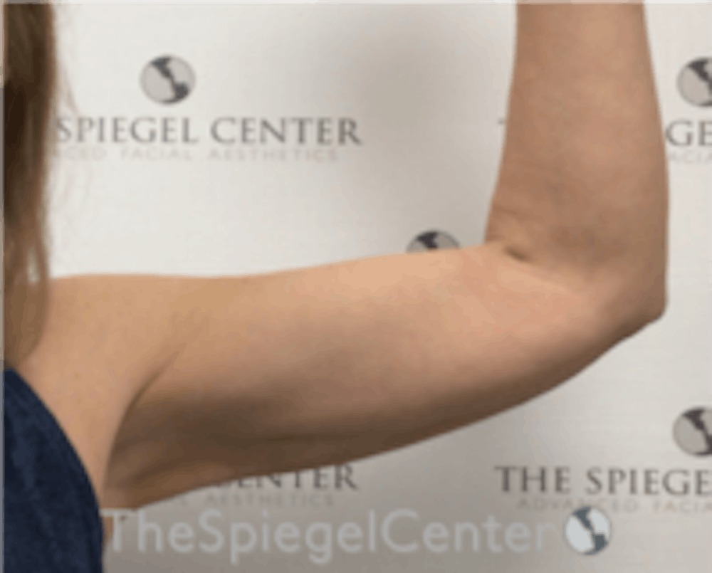 Arm Lift with BodyTite