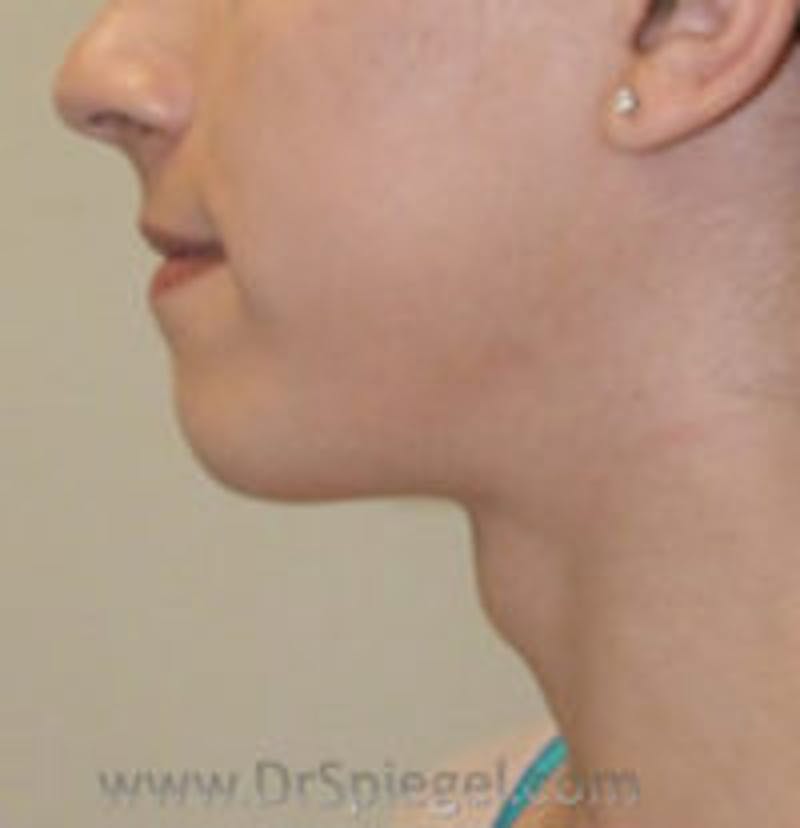 Trachea Shave Before & After Gallery - Patient 157140159 - Image 1