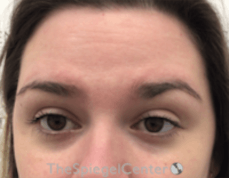 Botox Browlift Before & After Gallery - Patient 157140163 - Image 1