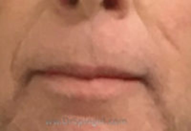 Lip Augmentation / Lip Implant / Lip Lift Before & After Gallery - Patient 157140161 - Image 1