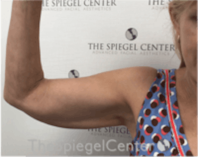 Arm Lift Before & After Gallery - Patient 297622 - Image 3