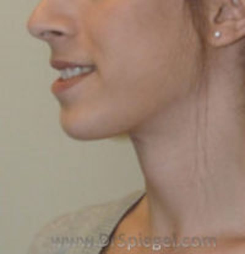 Trachea Shave Before & After Gallery - Patient 157140159 - Image 2