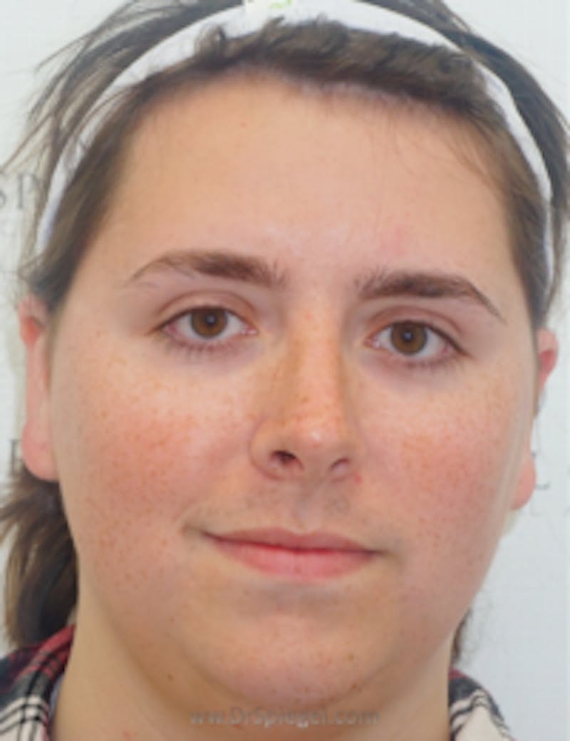 FFS Before & After Gallery - Patient 157140175 - Image 1