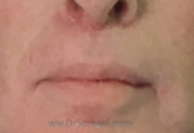 Lip Lift Before & After Gallery - Patient 157140161 - Image 2