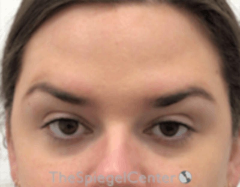 Botox Browlift Before & After Gallery - Patient 157140163 - Image 2