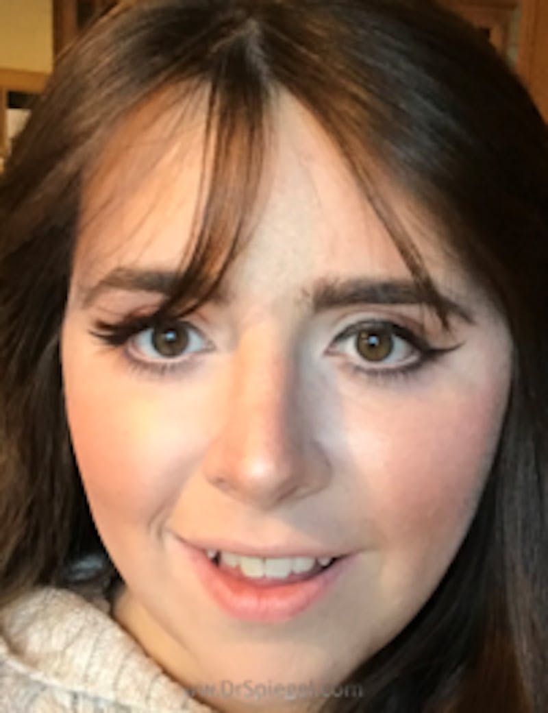 FFS Before & After Gallery - Patient 157140175 - Image 2
