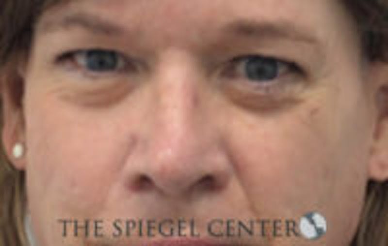 Rhinoplasty Before & After Gallery - Patient 157140169 - Image 4