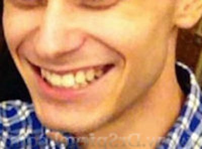 Mandible Contouring Before & After Gallery - Patient 157140172 - Image 1