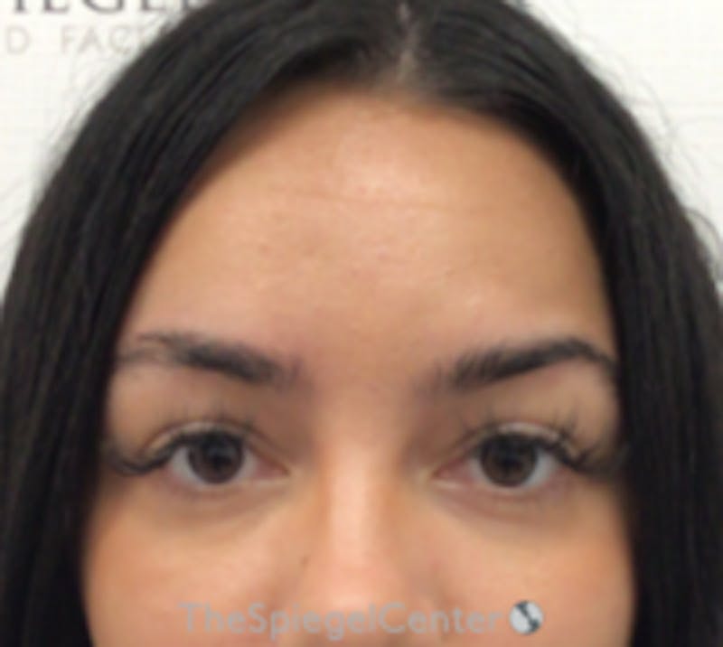 Botox Browlift Before & After Gallery - Patient 157140174 - Image 1