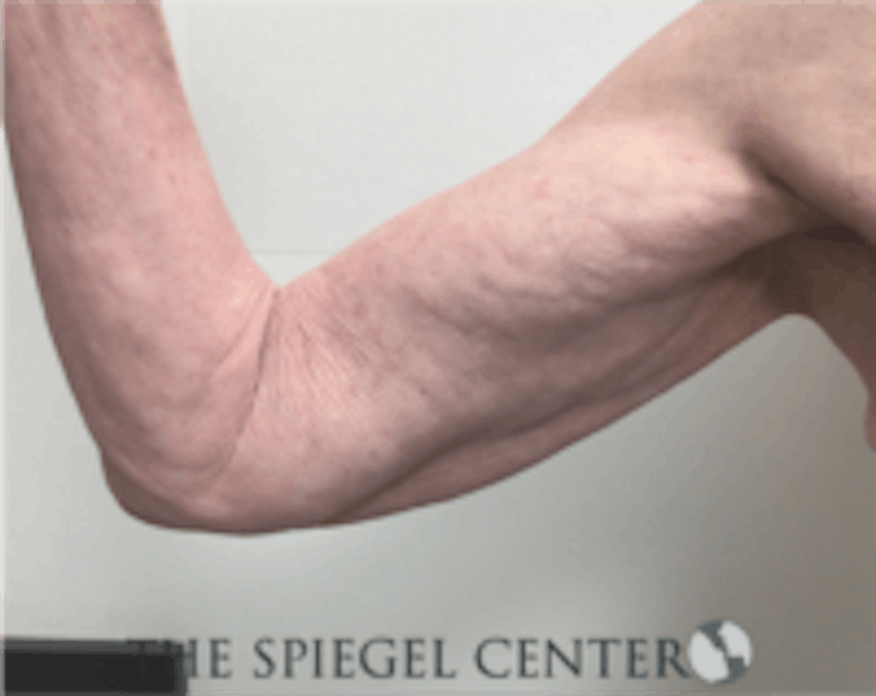 Bodytite Before & After Gallery - Patient 157140170 - Image 1