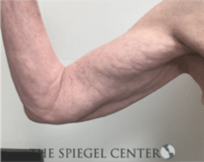 Arm Lift Before & After Gallery - Patient 822568 - Image 1