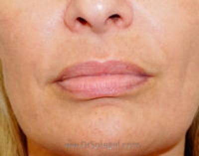 Lip Lift Before & After Gallery - Patient 157140168 - Image 1