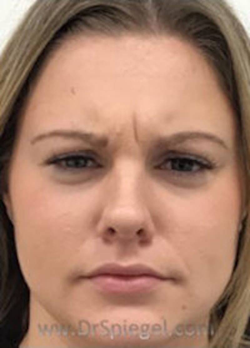 Botox / Dysport / Jeuveau / Xeomin Before & After Gallery - Patient 157140183 - Image 1