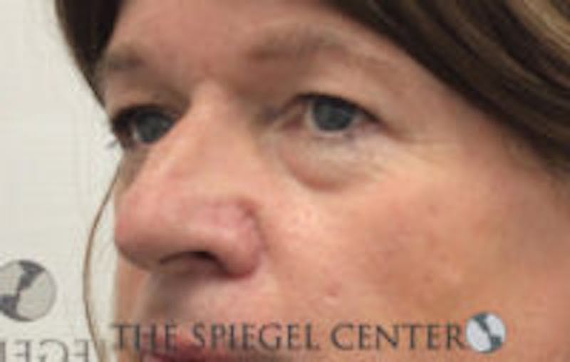 Rhinoplasty Before & After Gallery - Patient 157140169 - Image 1