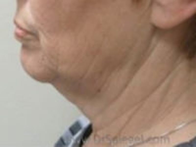 Neck Lift Before & After Gallery - Patient 157140173 - Image 1