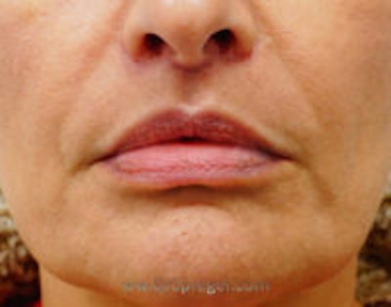 Lip Augmentation / Lip Implant / Lip Lift Before & After Gallery - Patient 157140168 - Image 2