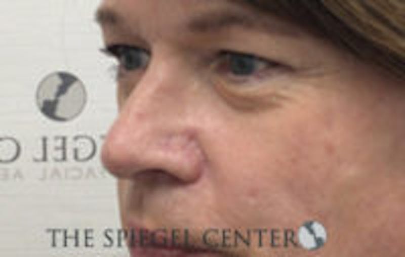 Rhinoplasty Before & After Gallery - Patient 157140169 - Image 2