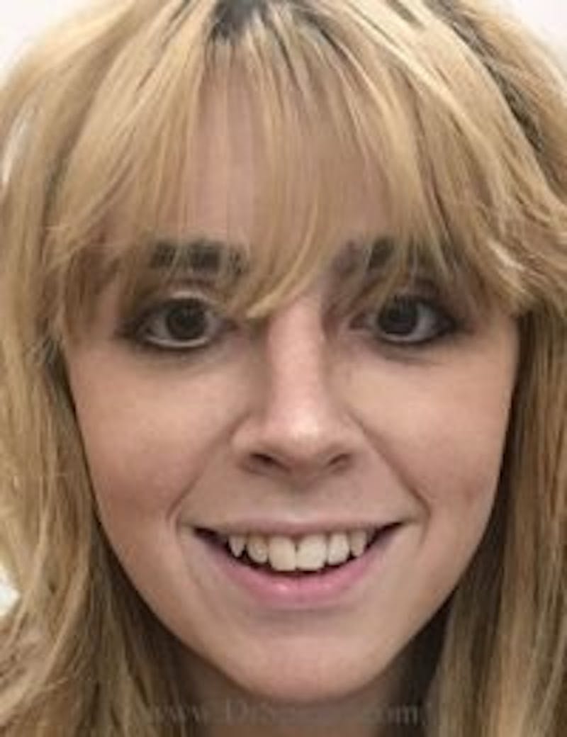 FFS Before & After Gallery - Patient 157140175 - Image 4