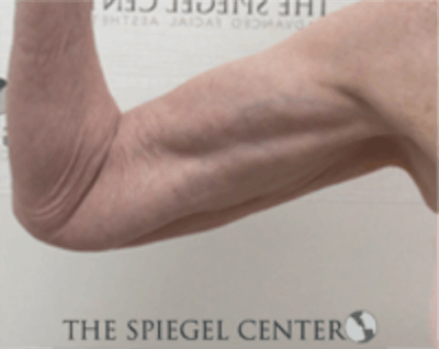 Bodytite Before & After Gallery - Patient 157140170 - Image 2