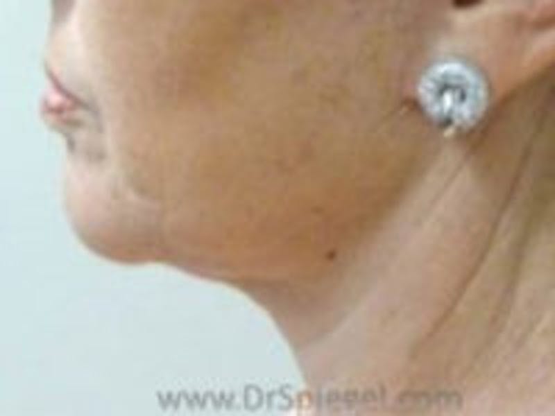 Neck Lift Before & After Gallery - Patient 157140173 - Image 2