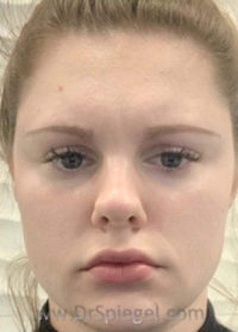 Botox / Dysport / Jeuveau / Xeomin Before & After Gallery - Patient 157140183 - Image 2