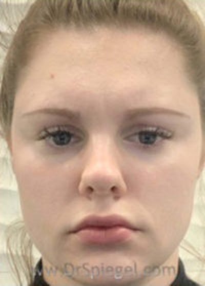 Botox / Dysport / Jeuveau / Xeomin Before & After Gallery - Patient 157140183 - Image 2