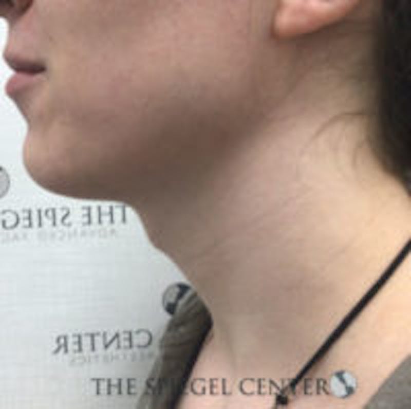 Trachea Shave Before & After Gallery - Patient 157140177 - Image 1