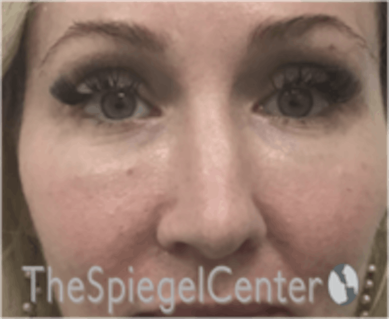 Rhinoplasty Before & After Gallery - Patient 157140186 - Image 3