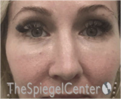 Rhinoplasty Before & After Gallery - Patient 157140186 - Image 3