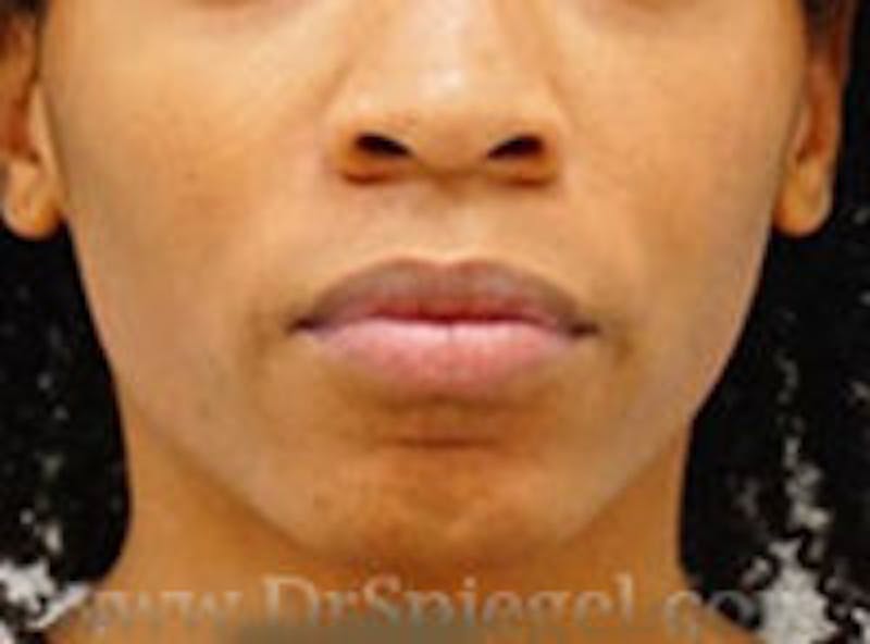 Mandible Contouring Before & After Gallery - Patient 157140179 - Image 1
