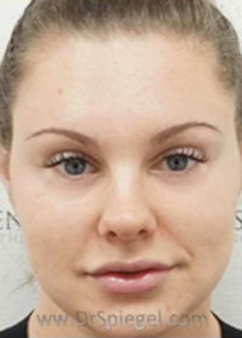 Botox / Dysport / Jeuveau / Xeomin Before & After Gallery - Patient 157140183 - Image 4