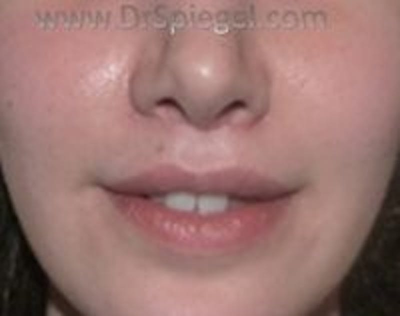 Lip Augmentation / Lip Implant / Lip Lift Before & After Gallery - Patient 157140178 - Image 2