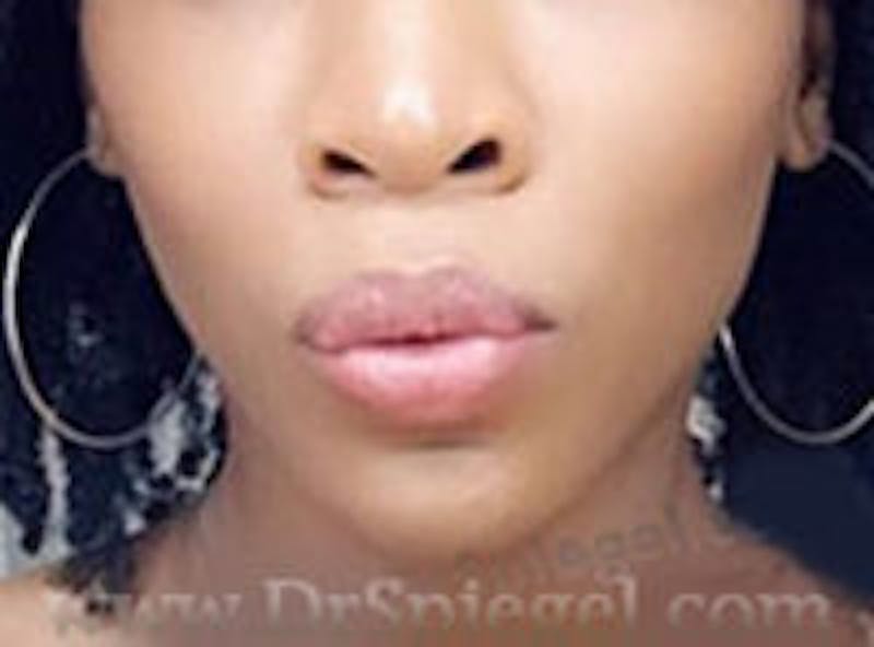 Mandible Contouring Before & After Gallery - Patient 157140179 - Image 2