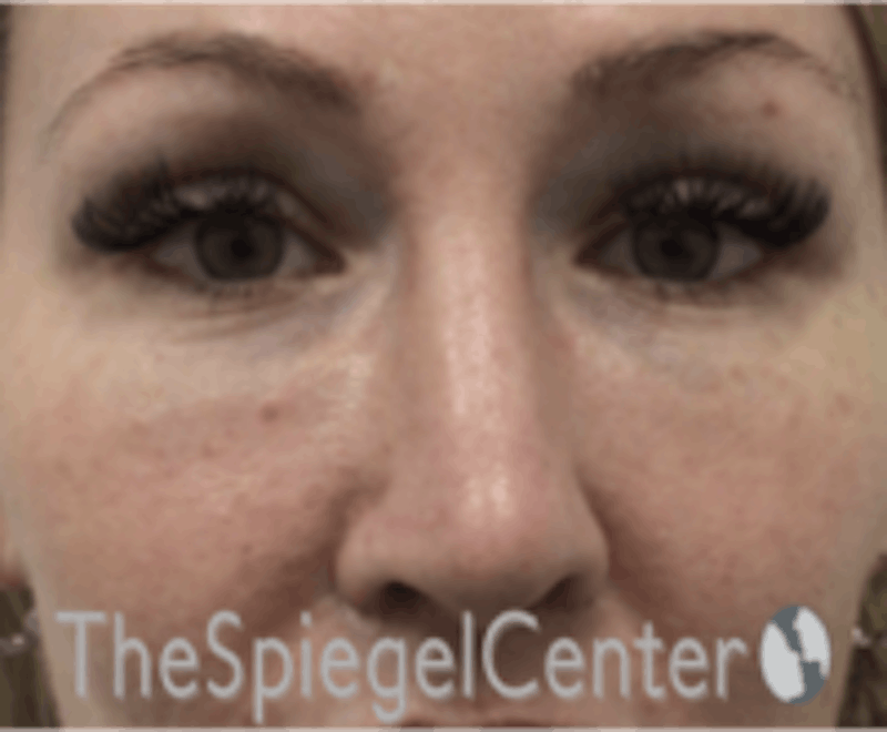 Rhinoplasty Before & After Gallery - Patient 157140186 - Image 4