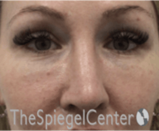 Rhinoplasty Before & After Gallery - Patient 157140186 - Image 4