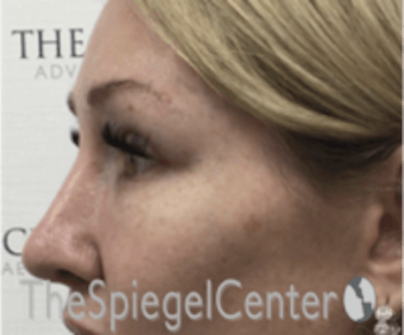Rhinoplasty Before & After Gallery - Patient 157140186 - Image 1