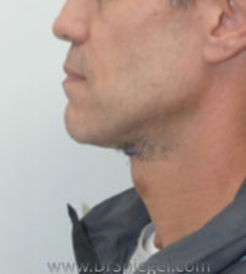 Trachea Shave Before & After Gallery - Patient 157140184 - Image 2