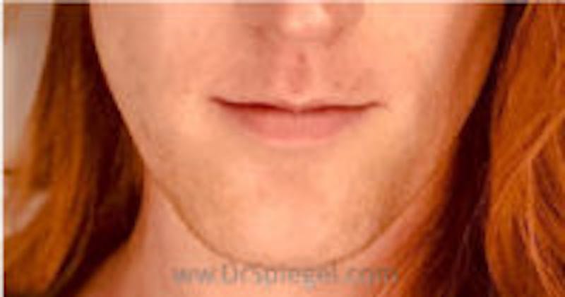 Mandible Contouring Before & After Gallery - Patient 157140190 - Image 1