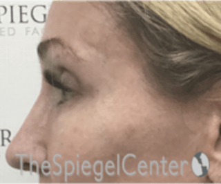 Rhinoplasty Before & After Gallery - Patient 157140186 - Image 2