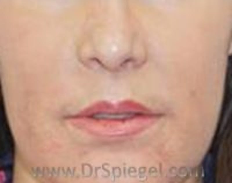 Lip Lift Before & After Gallery - Patient 157140187 - Image 2