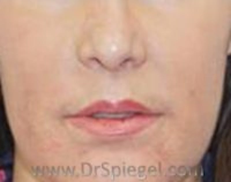 Lip Augmentation / Lip Implant / Lip Lift Before & After Gallery - Patient 157140187 - Image 2