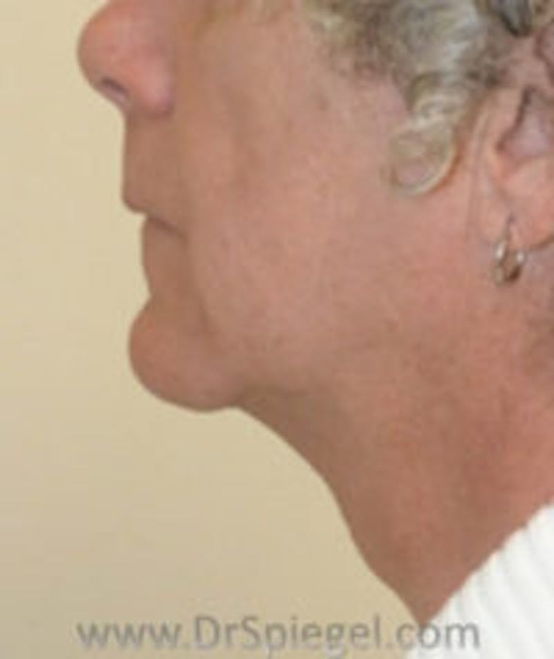 Trachea Shave Before & After Gallery - Patient 157140193 - Image 1