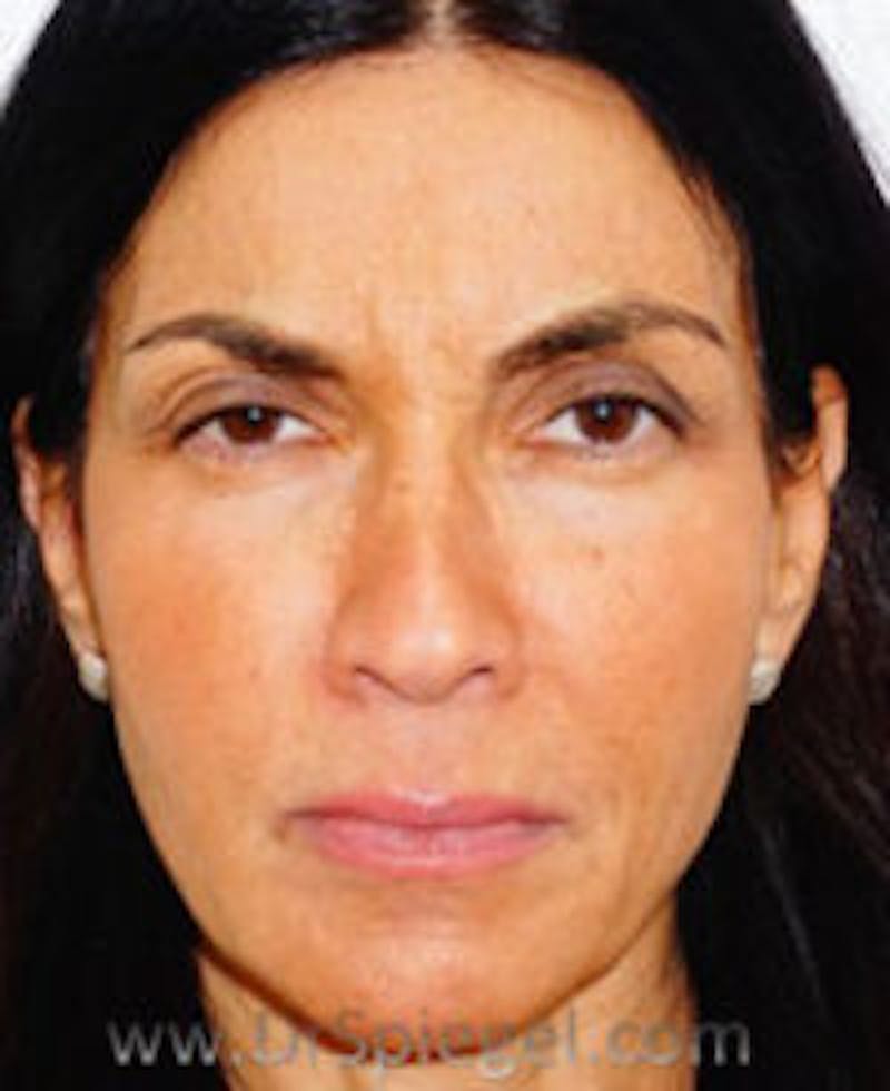 Botox / Dysport / Jeuveau / Xeomin Before & After Gallery - Patient 157140196 - Image 2