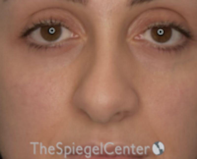 Rhinoplasty Before & After Gallery - Patient 157140202 - Image 3